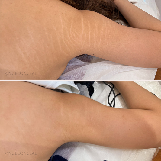 The Best Treatments for Stretch Mark Removal