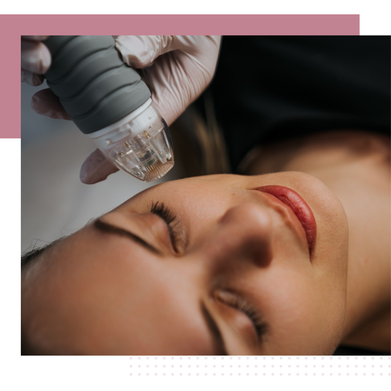 Microneedling Facial Treatment In Scottsdale AZ | TGS Lab