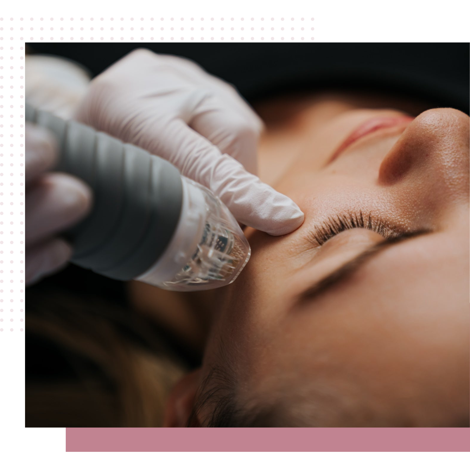 Microneedling In Scottsdale AZ | TGS Lab