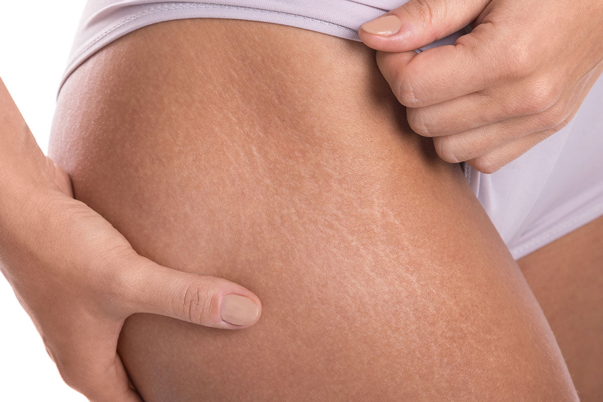 Scar & Stretch Mark Revision