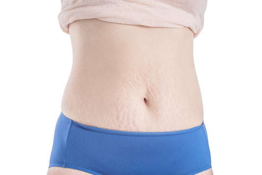 stretch marks