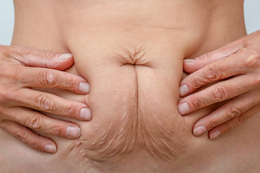 stretch marks