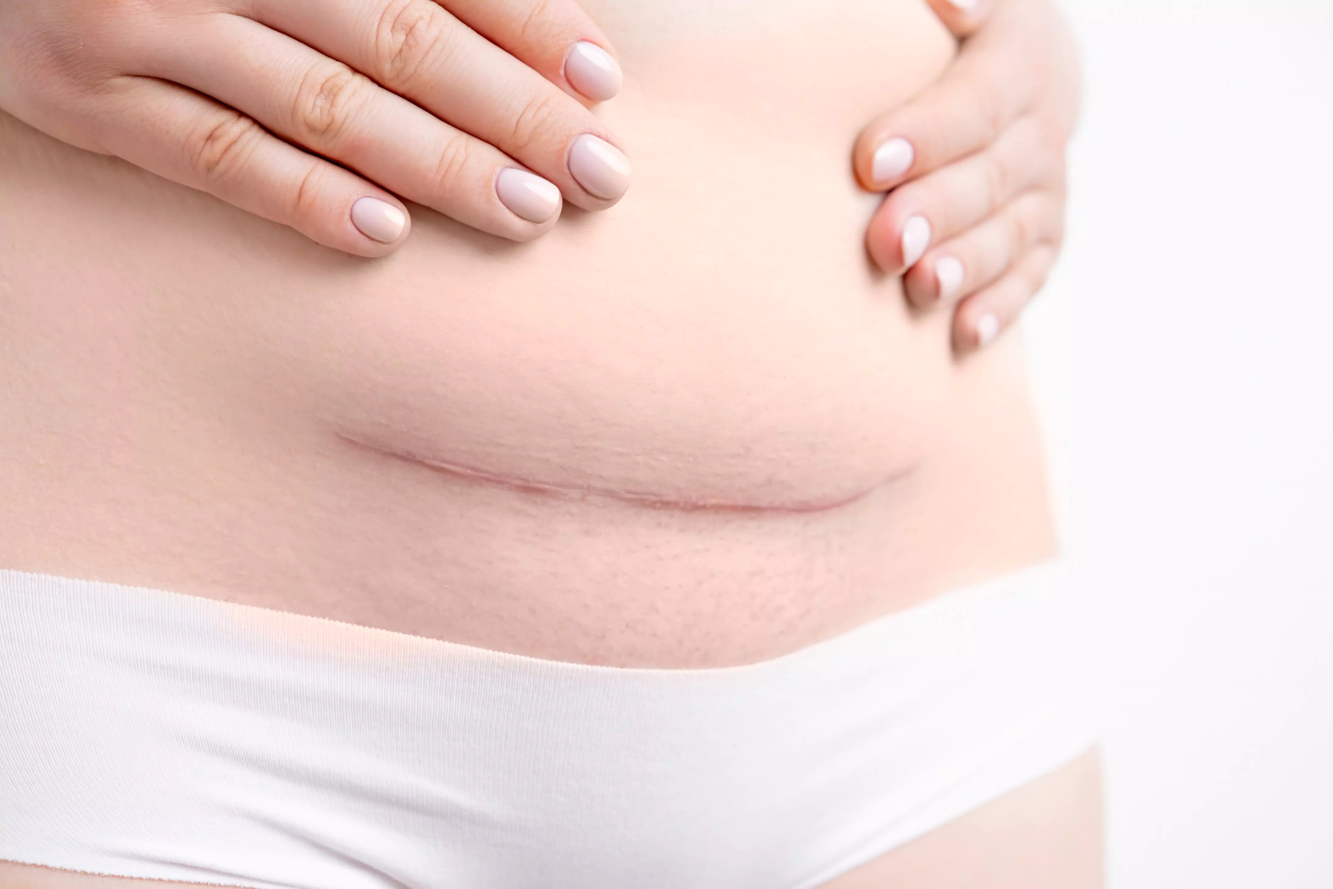 A Guide to Fading C-Section Scars – TGS Lab