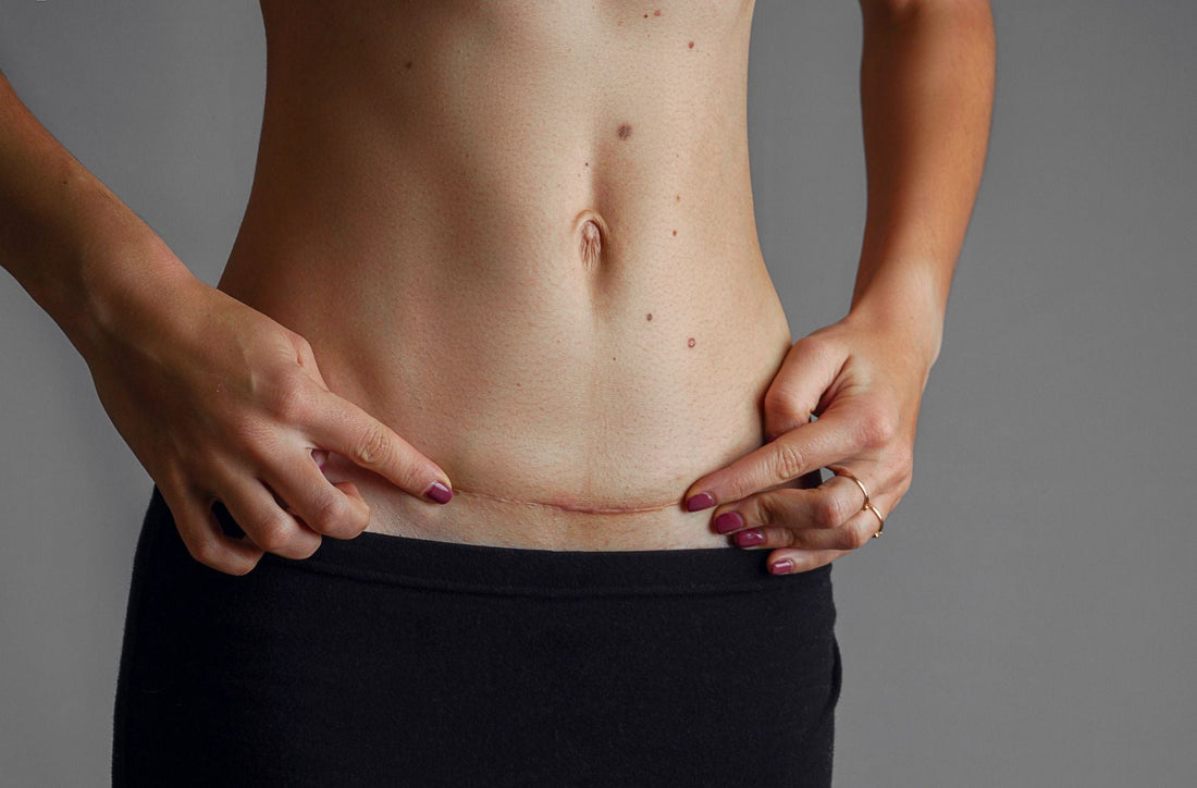 Scottsdale Tummy Tuck Scar Tattoos After Divorce or Weight Loss