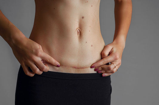 Scottsdale Tummy Tuck Scar Tattoos After Divorce or Weight Loss