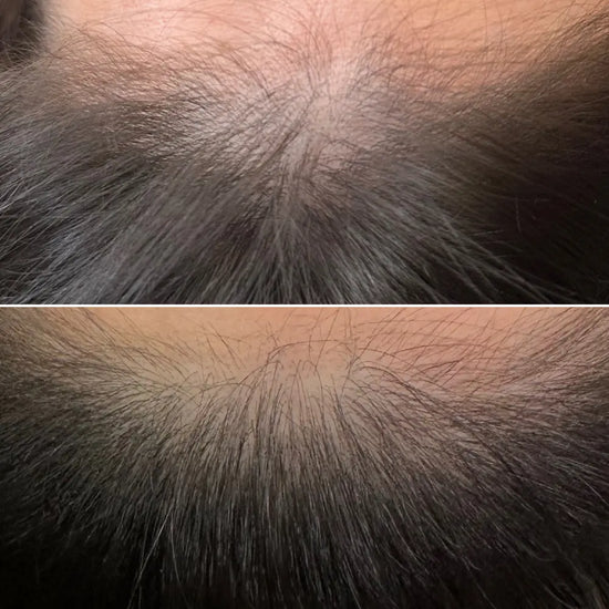 Before and after comparison of hair density on a scalp.