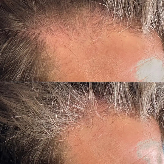 Before and after comparison of a person's scalp with hair growth.